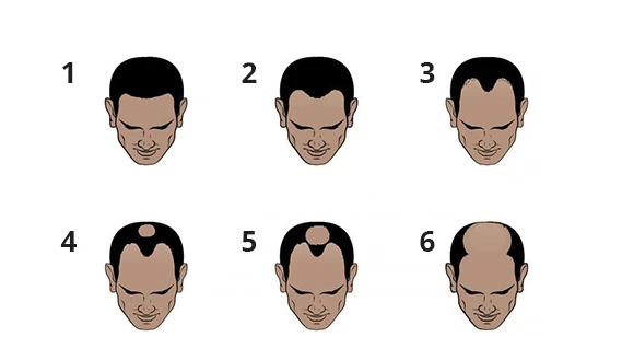 Hair Loss Stage